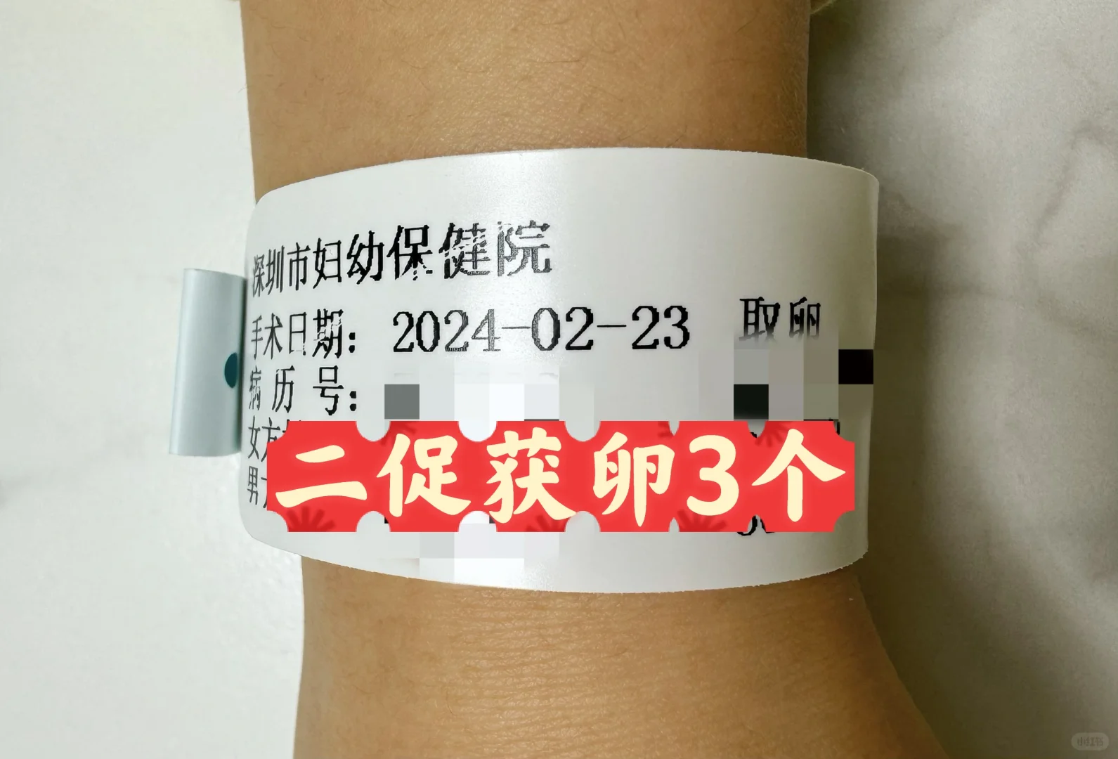 2.23，试管二促取卵3个